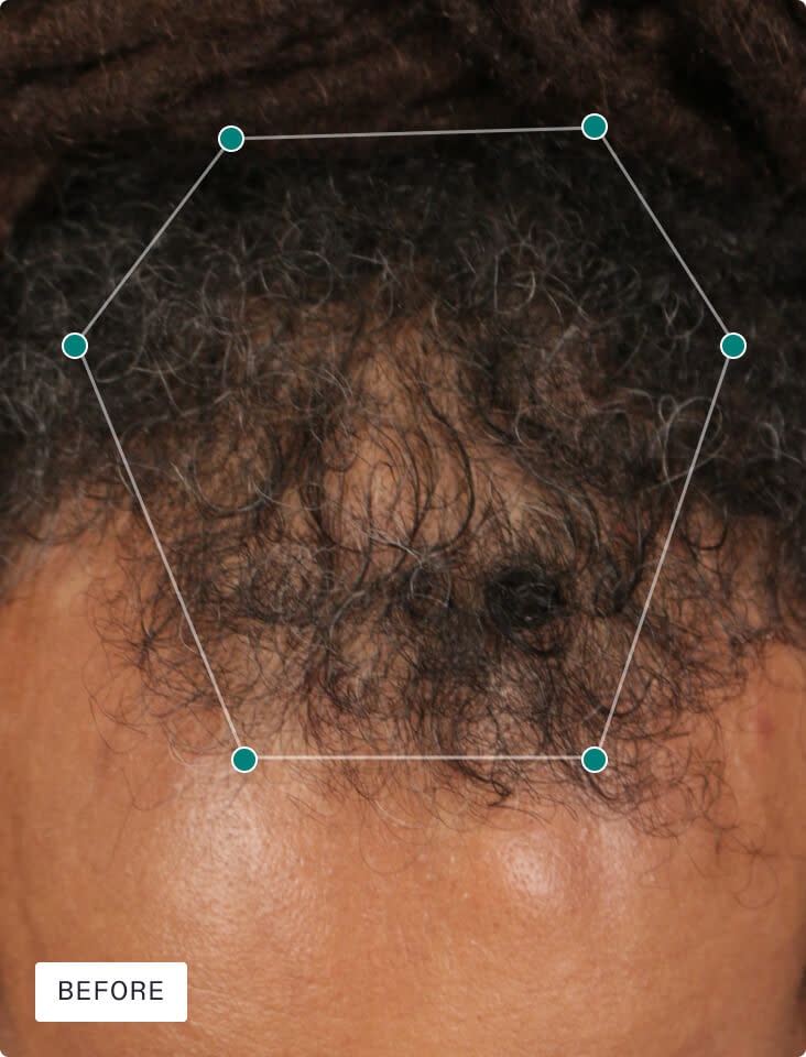 Nutrafol Men's Hair Growth Supplement - 1 Month Supply